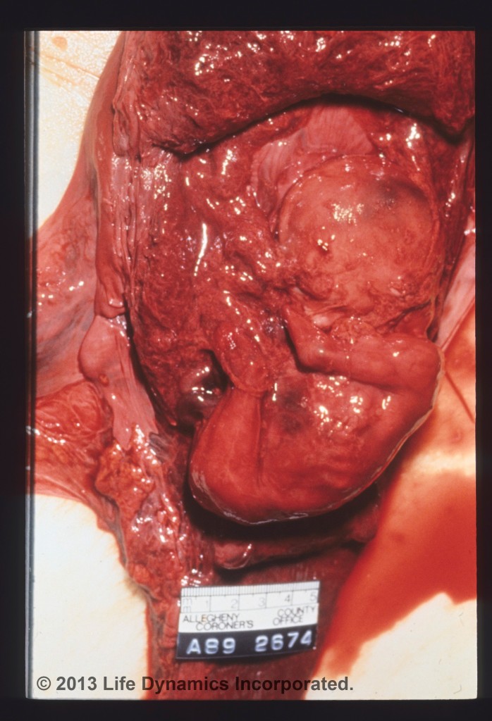 Unborn Autopsy Photo Marla's Babyphoto-41-698x1024
